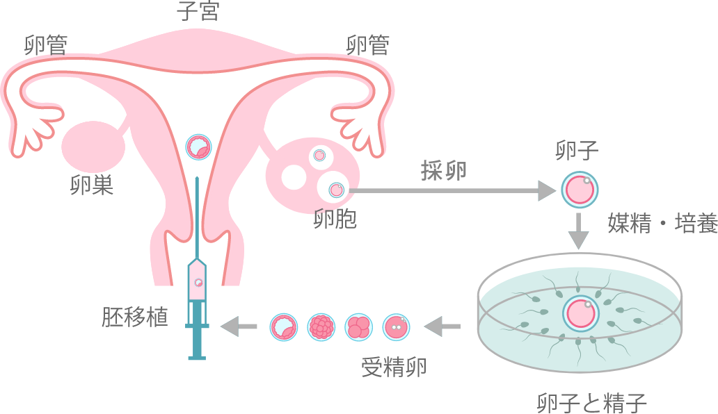 体外受精とは
